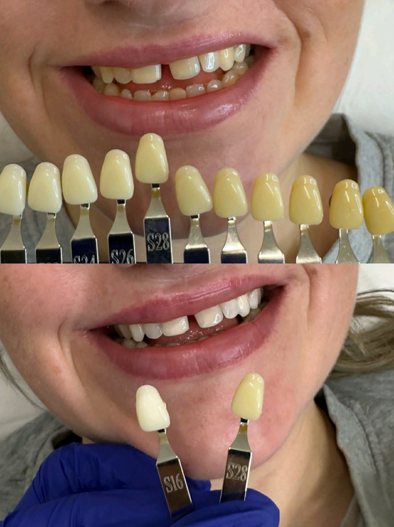 Teeth Whitening Peterborough: Get a Brighter Smile Today