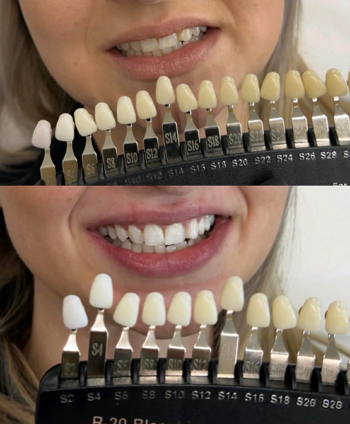 Teeth Whitening Stamford: A Brighter Smile in South Lincolnshire