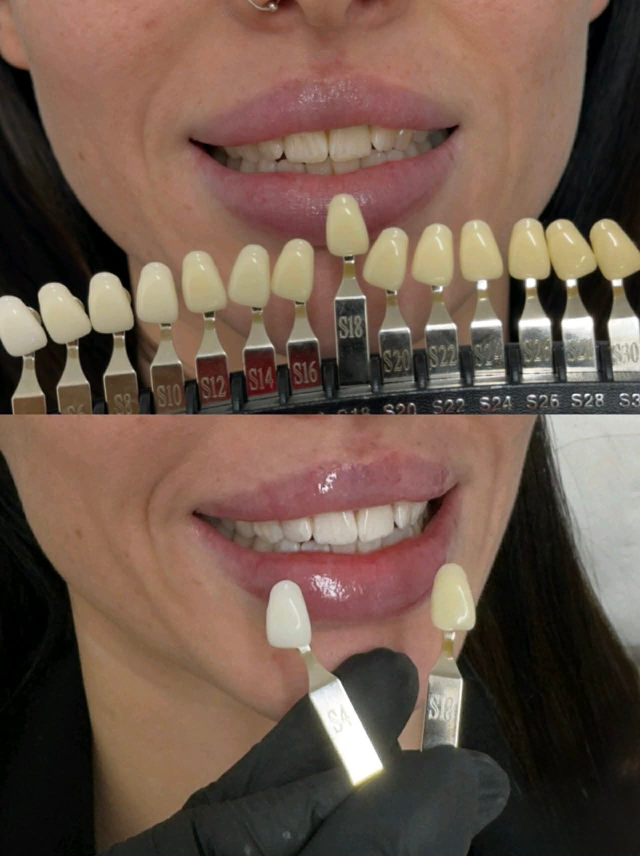 Teeth Whitening Wisbech: Your Brightest Smile in the Fens