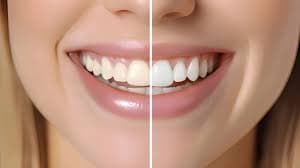 Laser Teeth Whitening Peterborough: Brighter Smile in 60 Minutes