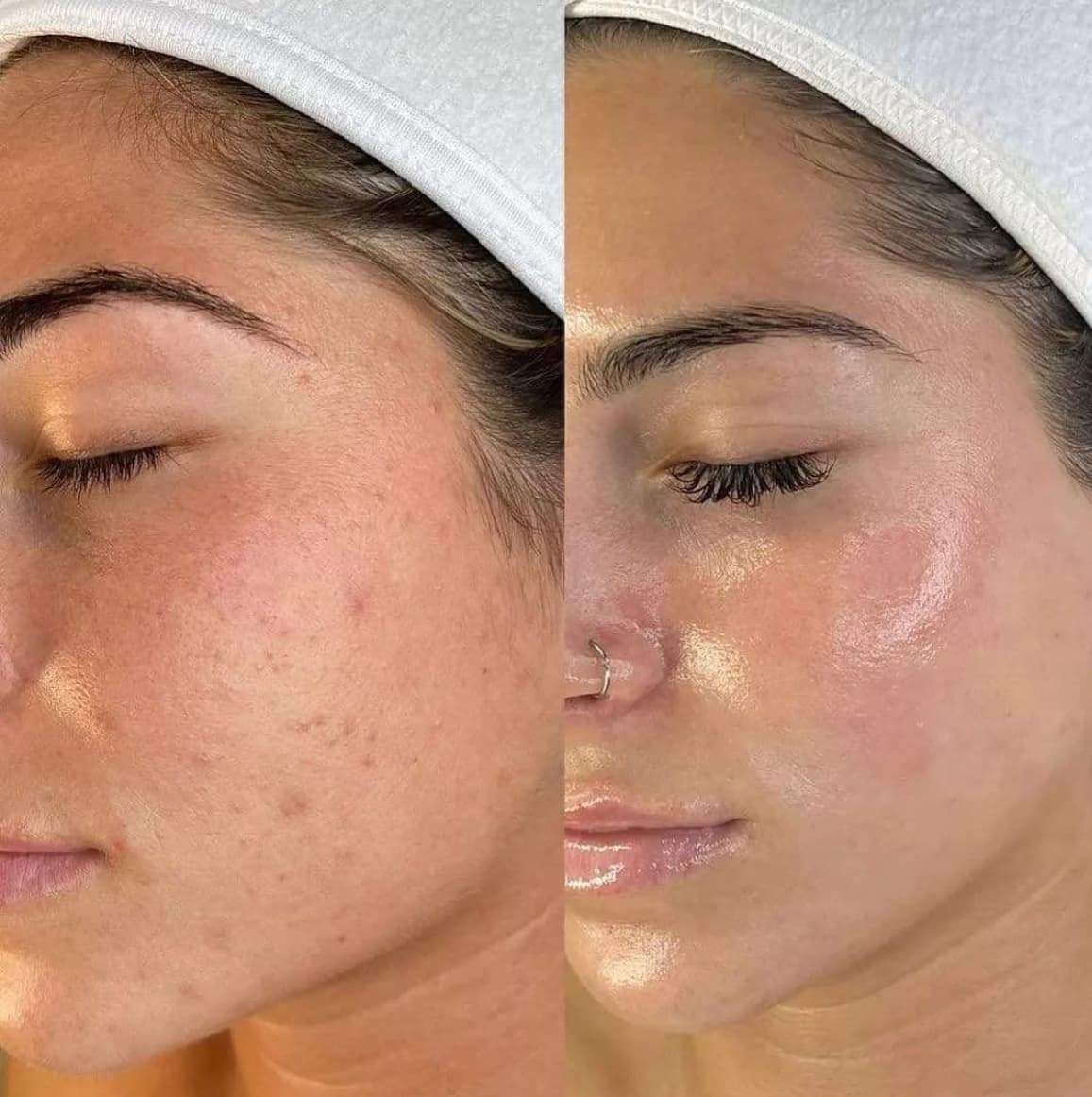 BB Glow facial treatment at Permanent by Juste